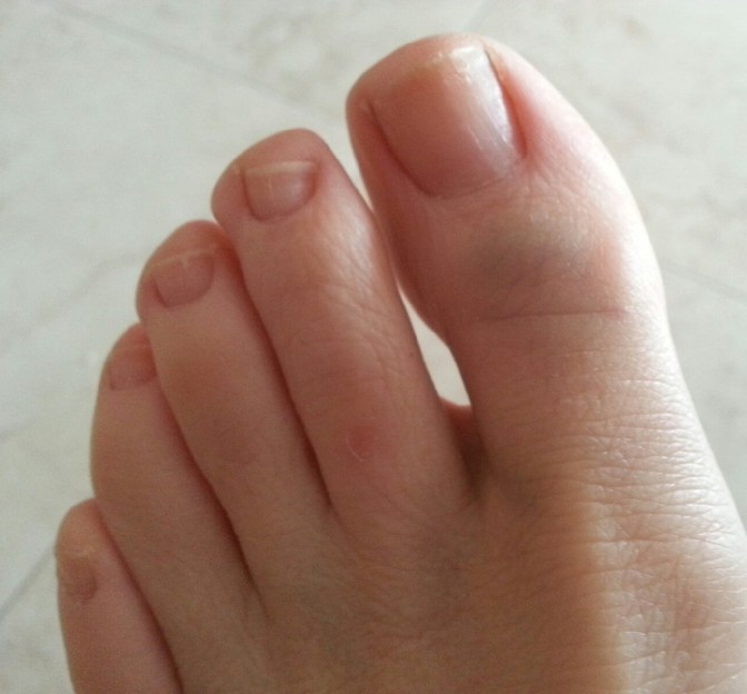 If you look closely, you can see a slight discoloration of my big toe near the joint and at the lower left... but no lump. :)